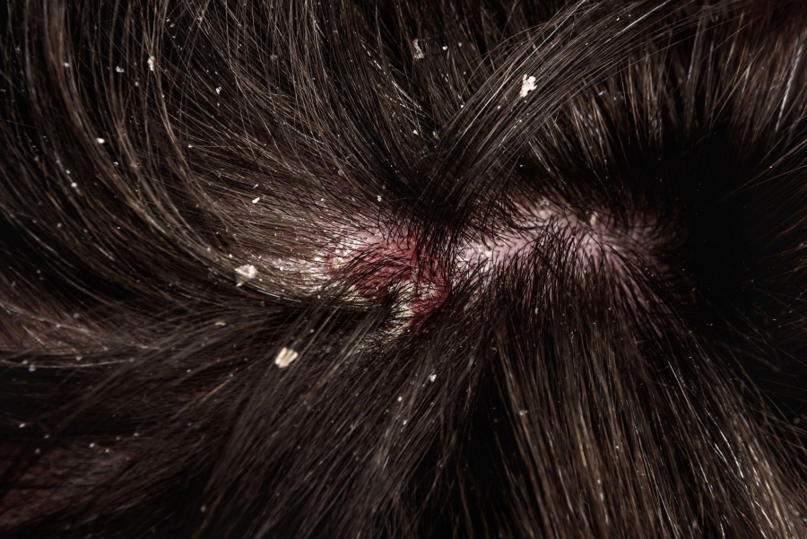 Rụng tóc ở nam giới – Nguyên nhân do đâu? Có phải do bệnh lý?